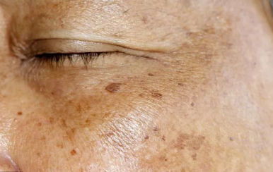 可怕的是老年斑，90后也不放過(guò)