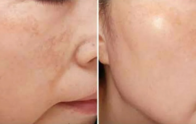 都說(shuō)祛斑難，對(duì)不起，那是他因?yàn)槟銢]選對(duì)方法！